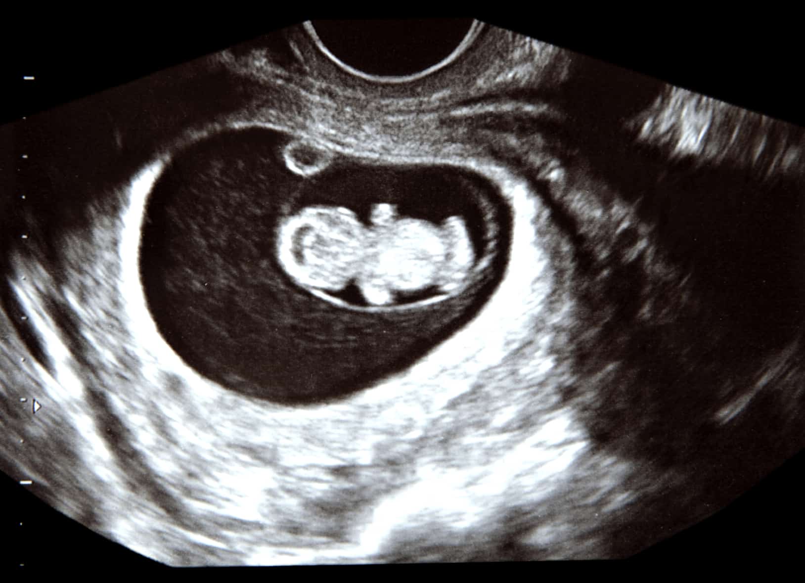 9 Weeks Pregnant Ultrasound 